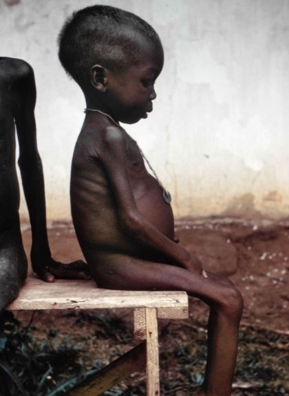 Fotografia d'un infant desnodrit amb la panxa inflada a un camp de refugiats de Biafra Fotografia d'un infant desnodrit amb la panxa inflada a un camp de refugiats de Biafra