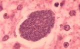 Histopatologia de la malària exoeritrocítica en formes hepàtiques